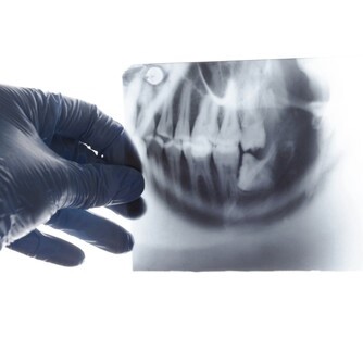 diagnostyka obrazowa zebow w Bielany Dental, rtg punktowe